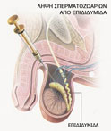 λήψη σπερματοτοζωαρίων από επιδιδυμίδα