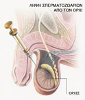 λήψη σπερματοζωαρίων από όρχη