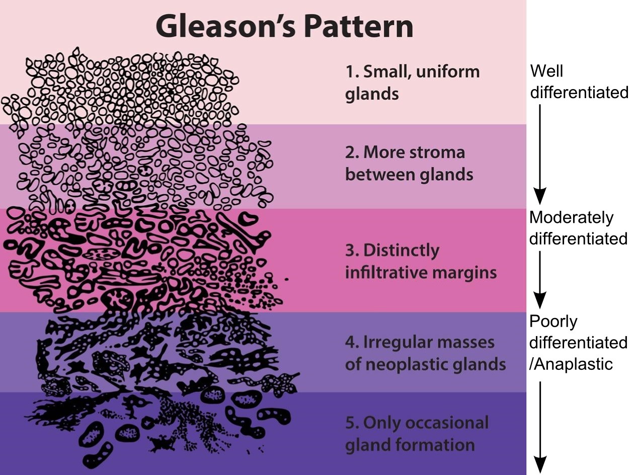 Gleason's Pattern