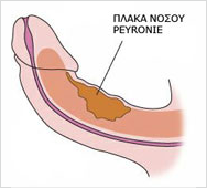 Πλάκα Νόσου Peyronie