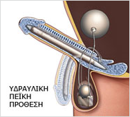 Υδραυλική Πεϊκή Πρόσθεση