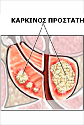 καρκίνος προστάτη