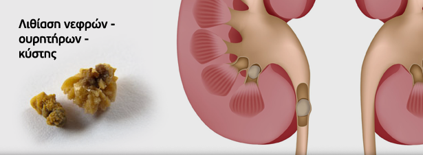 Λιθίαση νεφρών, ουρητήρων κύστης