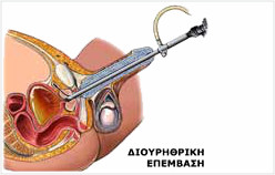 Διουρηθρική Επέμβαση