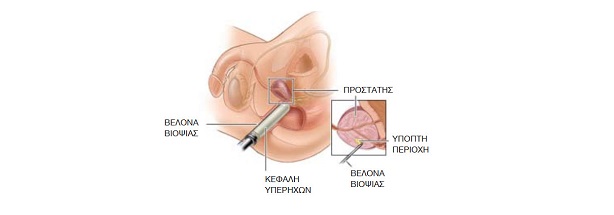 Βιοψία του Προστάτη