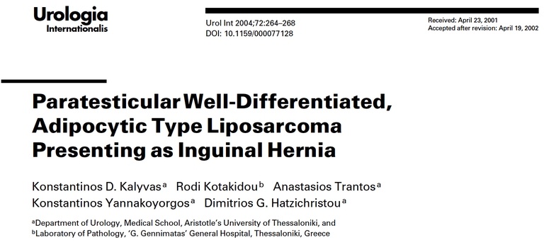 5. Paratesticular Well Differentiated, Adipocytic Type Liposarcoma Presenting ας Inguinal Hernia