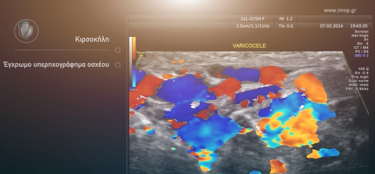 9. Υπερηχογράφημα Όσχεου