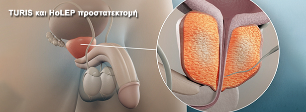 TURIS και HoLEP προστατεκτομή