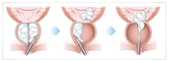 Χειρουργική με Holmium Laser